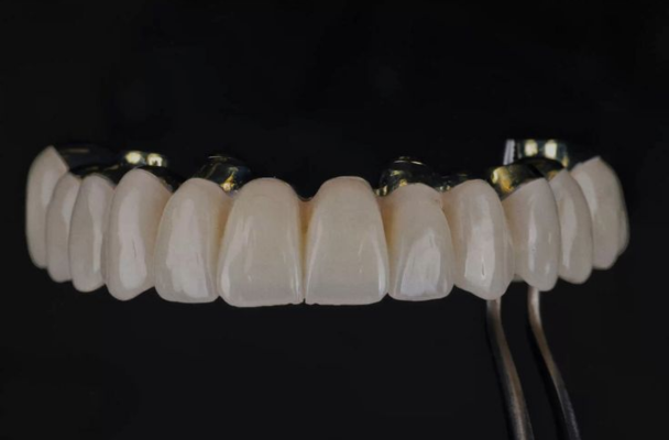 RĂNG SỨ CERCON HT 